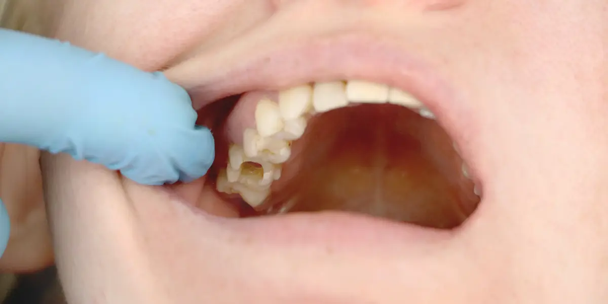 Dente furado: Guia completo para prevenção e tratamento