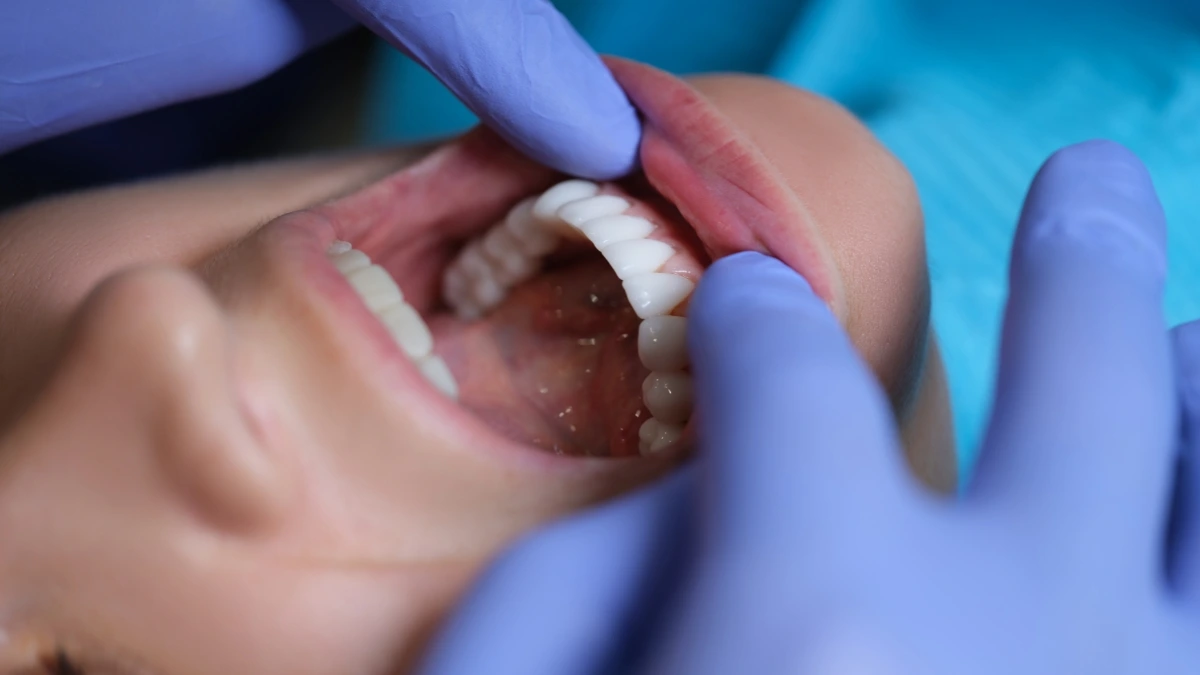 Tem que fazer manutenção de facetas? Guia para a longevidade do seu sorriso
