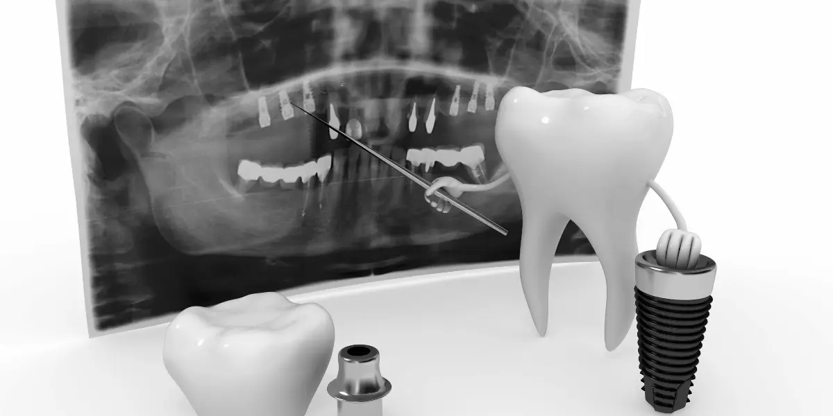É normal ver o parafuso do implante dentário? Entenda cada etapa