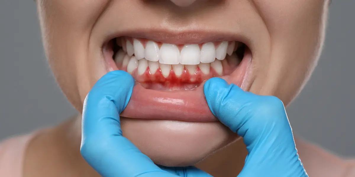 Dentista Gengiva Inflamada em Taguatinga OdontoLinea