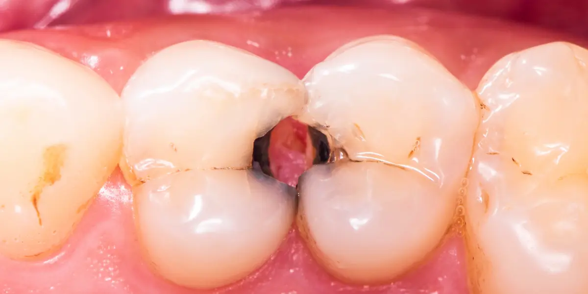 5 efeitos da cárie: tudo o que você precisa saber