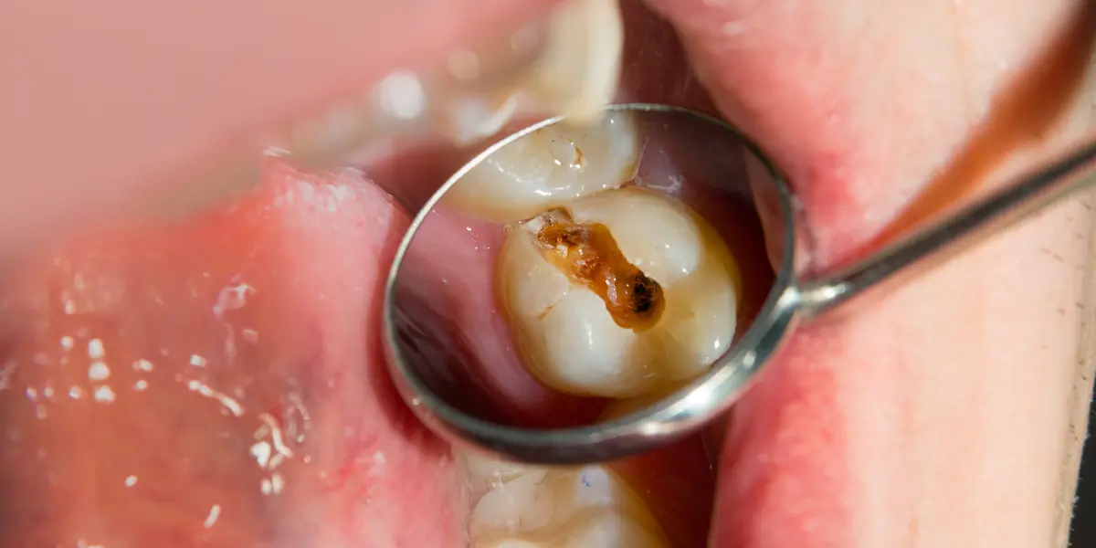 Cárie profunda: como prevenir, tratar e salvar seu sorriso!