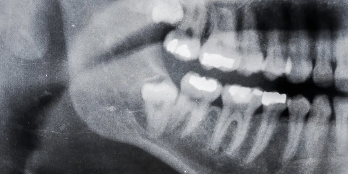 Dente impactado: Causas, sintomas e tratamento