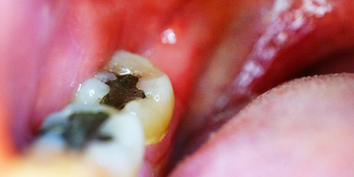 Dente Furado Causa Mau Hálito? Descubra a Verdade Aqui!