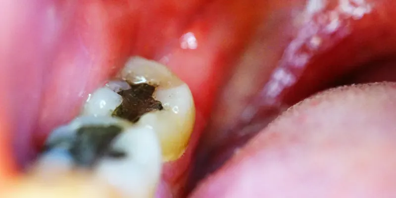 Dente Furado Causa Mau Hálito? Descubra a Verdade Aqui!