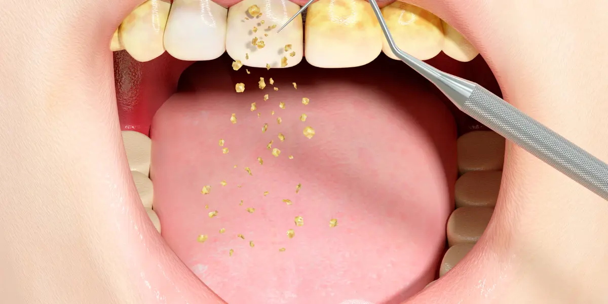 Descubra Como o Tártaro Causa Mau Hálito e Como Evitá-lo