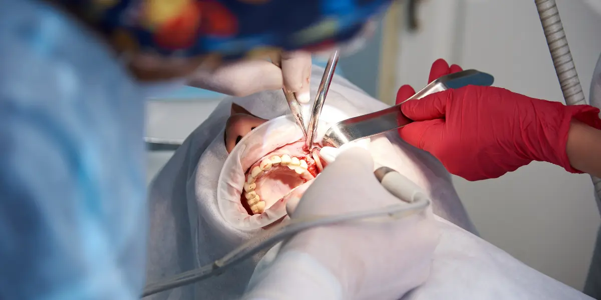 Cirurgia de Enxerto Ósseo Dentário: Tudo o que precisa saber