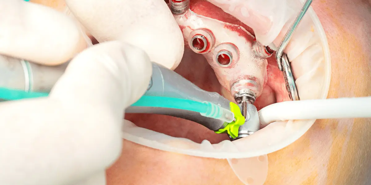 Protocolo de implantes superior: Revolução na odontologia moderna