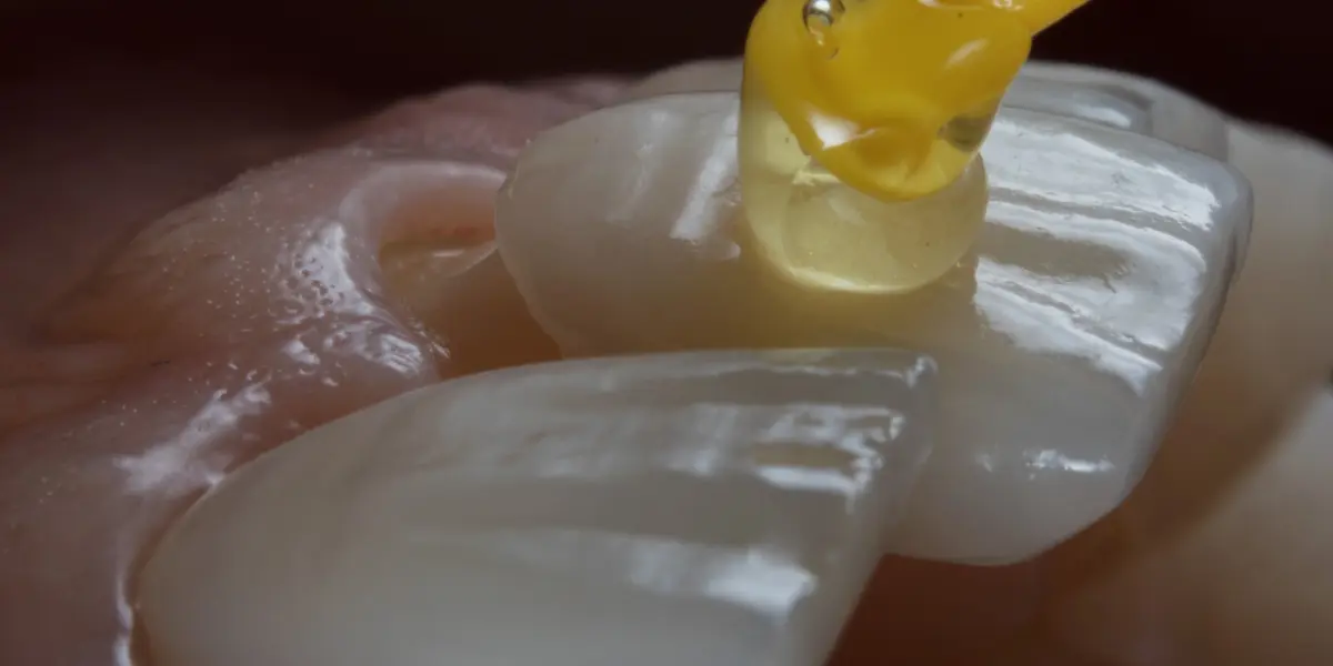 Qual a durabilidade de uma faceta? Entenda a longevidade do tratamento