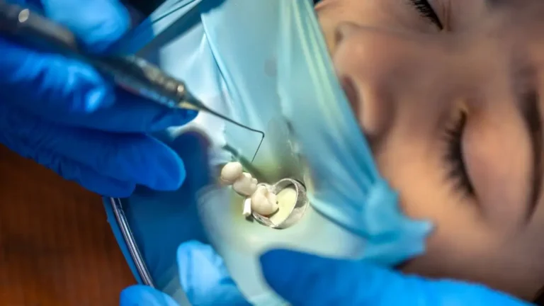 Como funciona o enxerto ósseo dentário