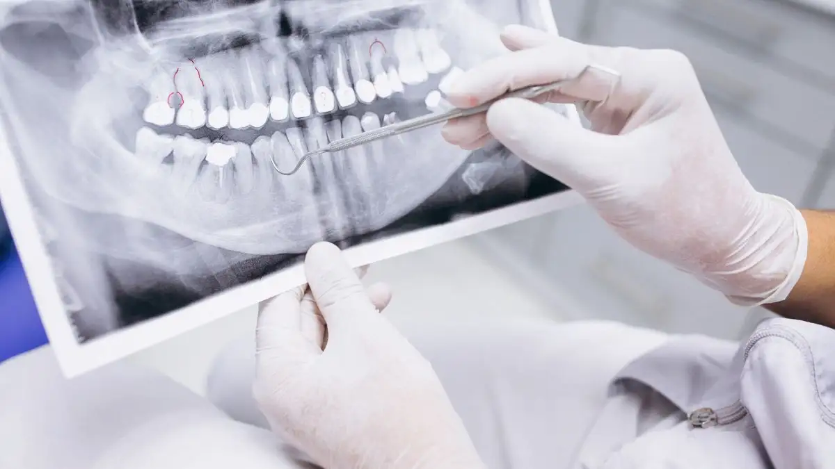 Qual o melhor enxerto ósseo dentário: Guia para uma escolha informada