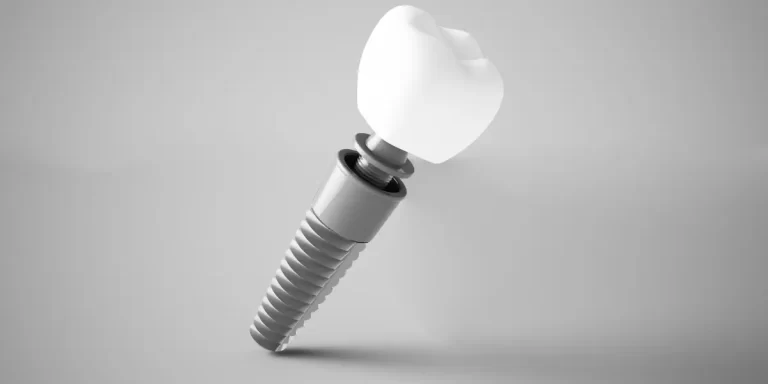 Como é Feito o Provisório do Implante de Dentes