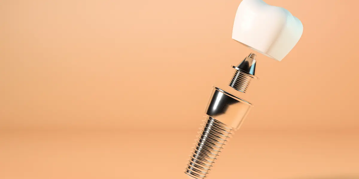 Qual tipo de implante mais usado no Brasil: Descubra o favorito