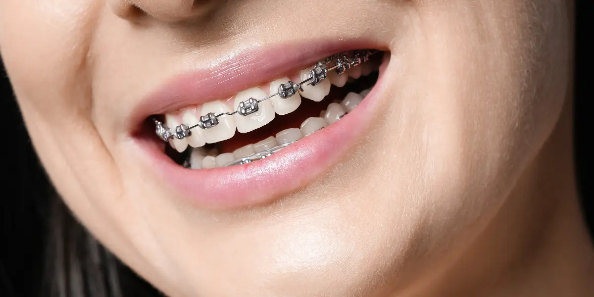 Quem Usa Prótese Dentária Pode Usar Aparelho Ortodôntico: Entenda