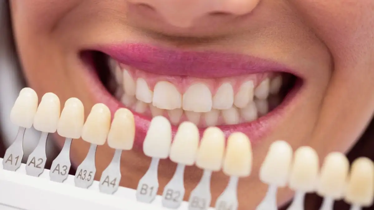 Quanto custa lente de resina em todos os dentes?