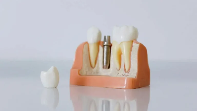 Quanto tempo dura um pino no dente