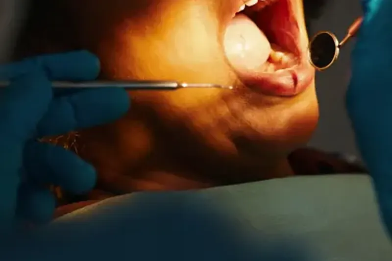 Cirurgia Oral Menor em Taguatinga - Clínica OdontoLinea