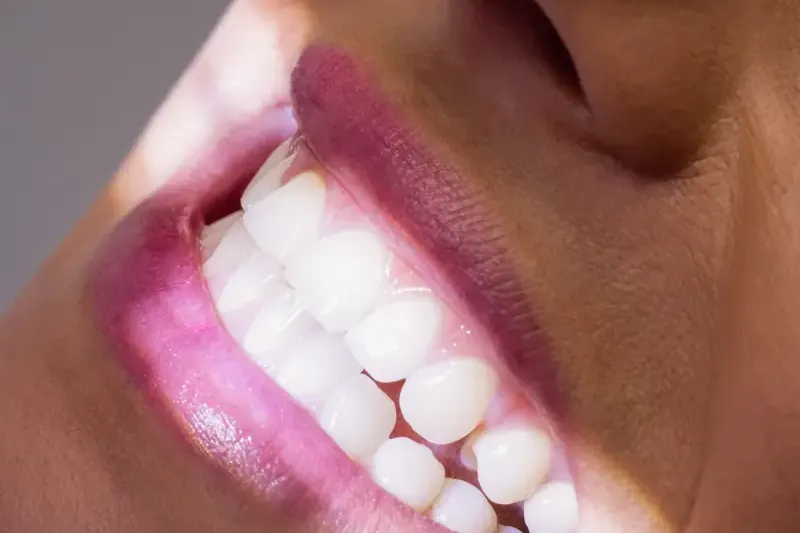 Lentes de Contato Dental em Taguatinga - Clínica OdontoLinea