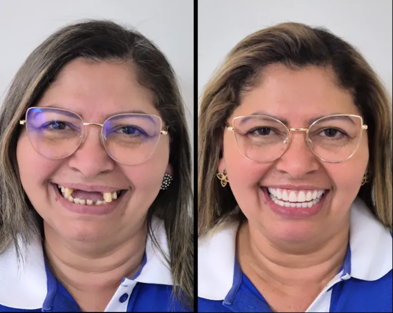 Prótese Dentária em Taguatinga - Clínica OdontoLinea