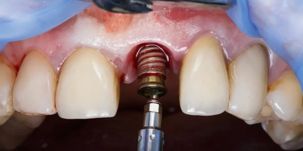 Quanto tempo dura um implante dentário