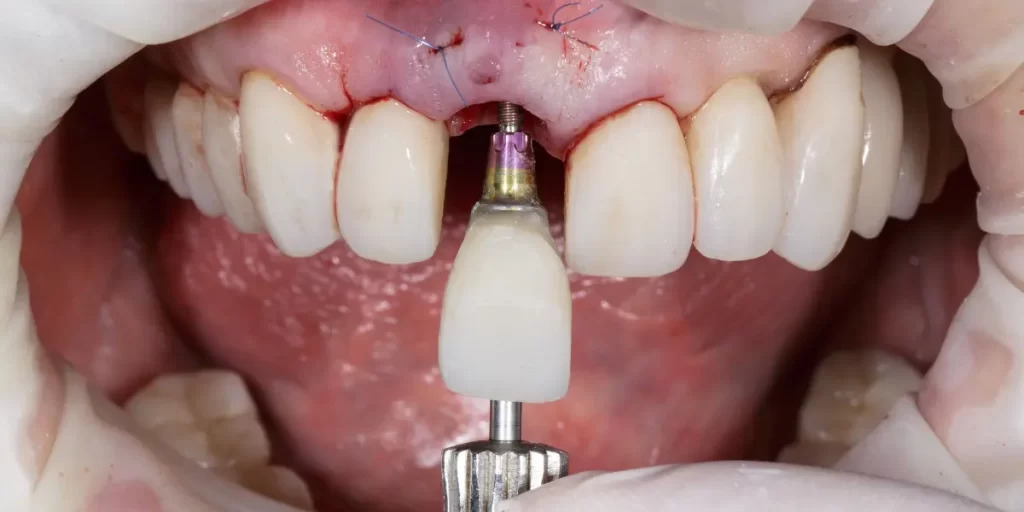 Quanto tempo depois do implante pode colocar o dente