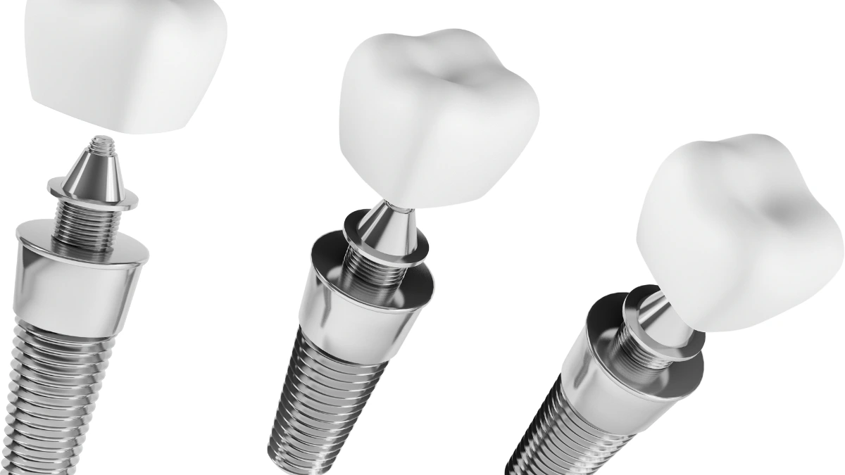 Qual a diferença entre pino e implante dentário
