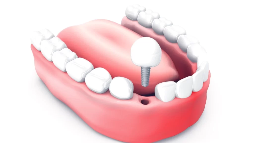 Tipos de Enxerto Ósseo Dentário