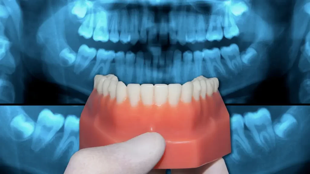 Protocolo de implantes inferior