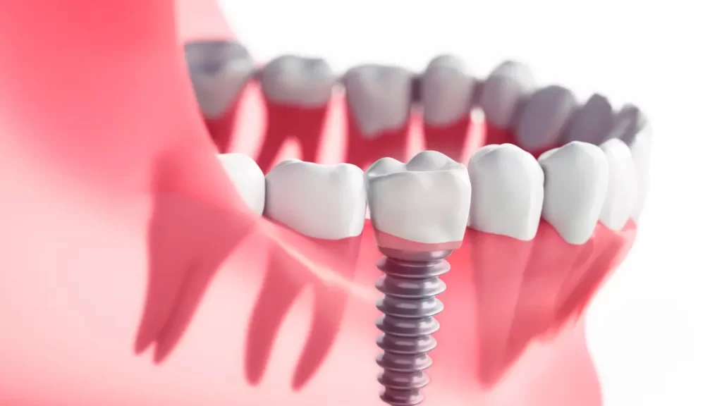 Especialista em implante dentário