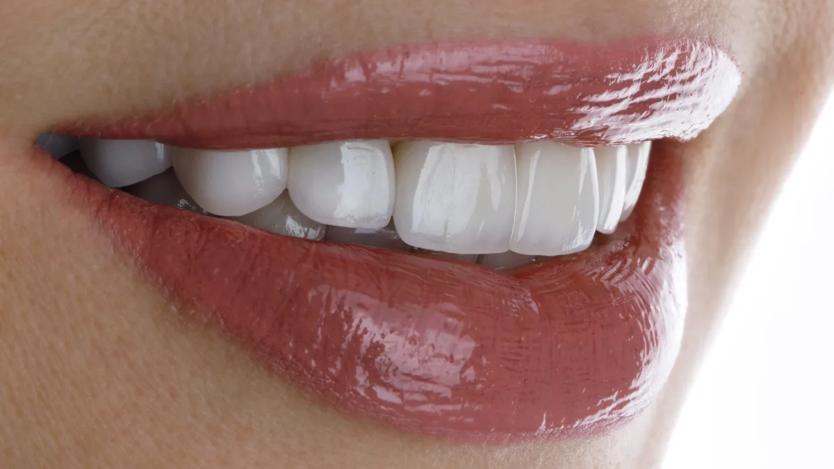 Lente de contato dental estraga os dentes