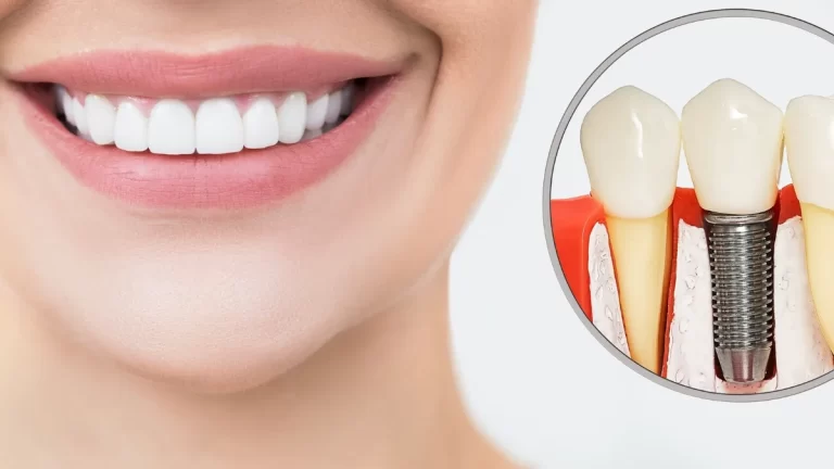 Como Fica o Sorriso Depois do Implante Dental