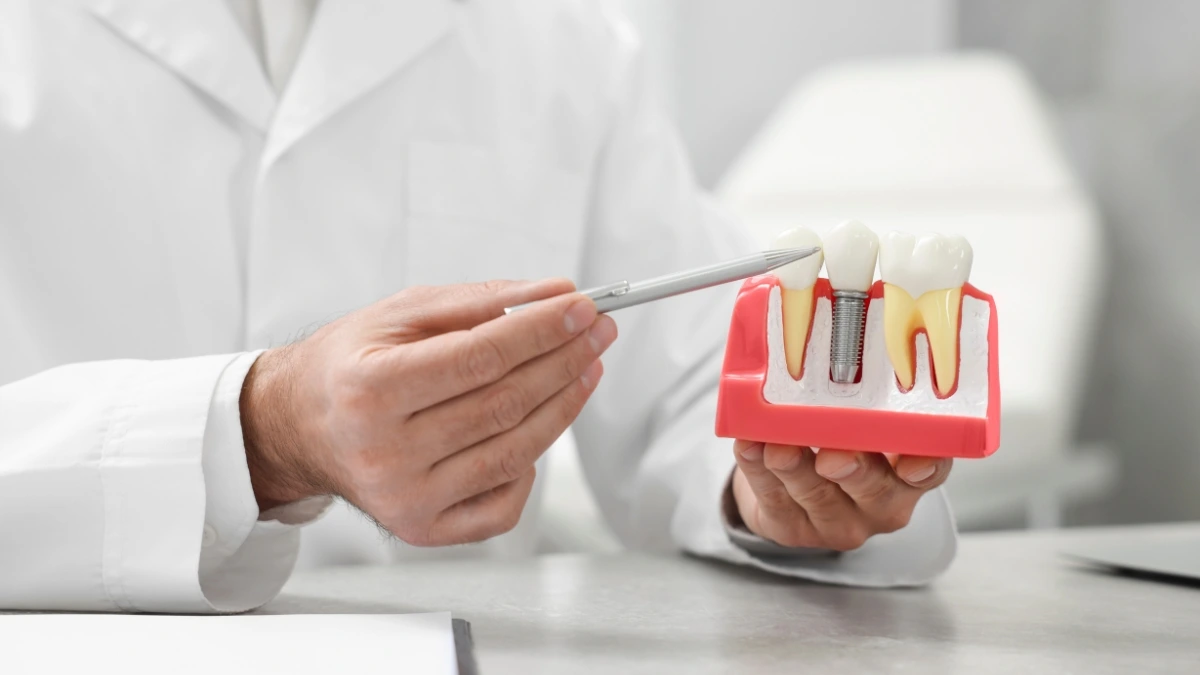 O que é necessário para fazer um implante dentário