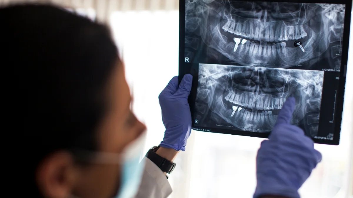 Quais São os Riscos de um Implante Dentário