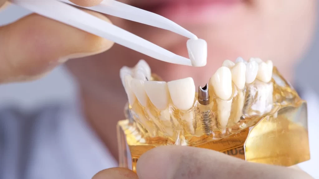 Qual a pior parte do implante dentário