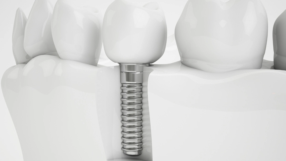 Quanto Tempo Depois do Implante Pode Colocar o Dente Provisório