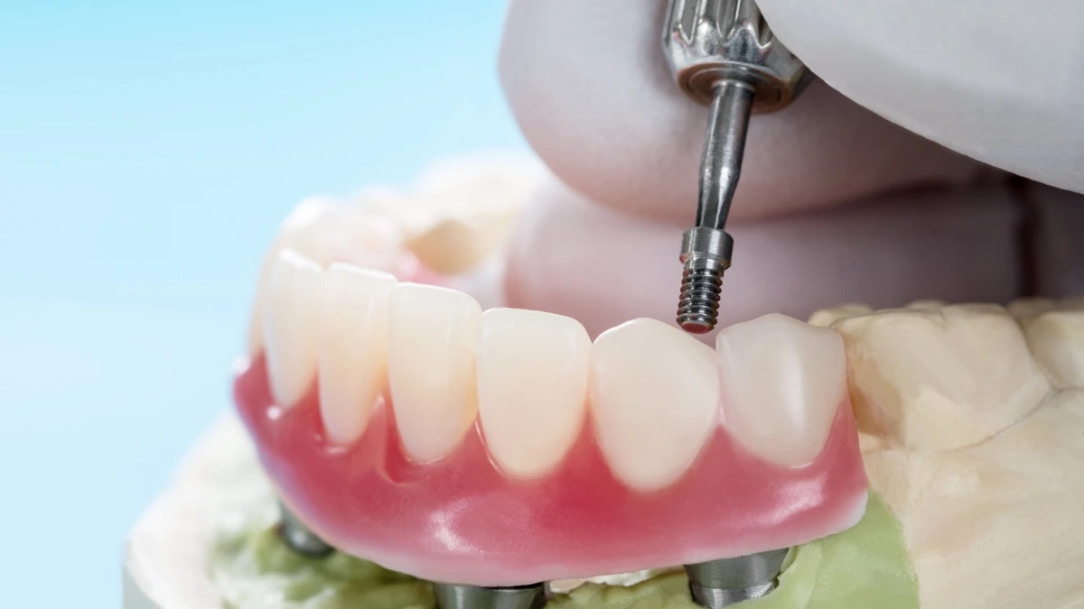 Quantos dentes podem ser implantados de uma vez