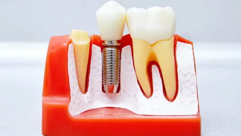 Tem Como Arrancar um Dente e Colocar um Implante no Mesmo Dia