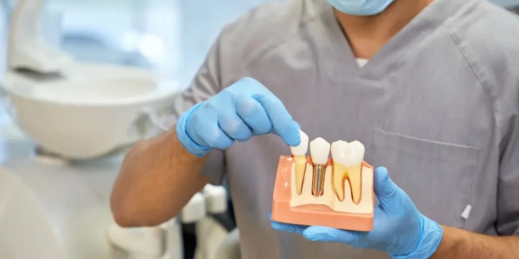 Implante Dentário Pode Cair