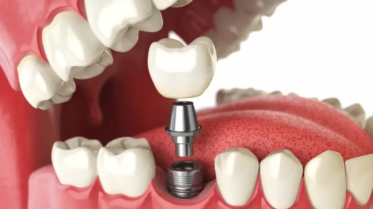 Quanto Custa Implantes Dentários